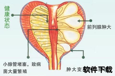 前列腺钙化是什么意思_病理机制与临床表现全面解析