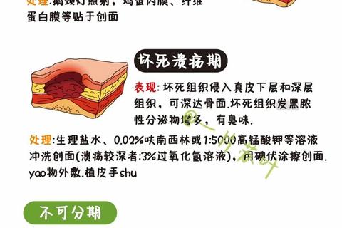 褥疮患者消炎药选择指南：适宜药物与注意事项