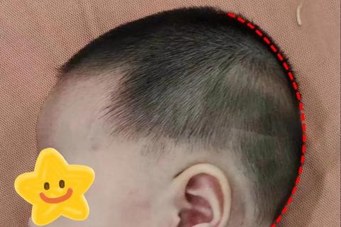 新生儿后脑勺骨头凸起：原因解析与应对建议