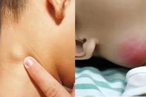 儿童颈部肿块实拍图解析：常见病因与应对指南