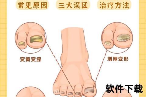 灰指甲治疗全攻略:科学用药与日常护理的有效结合 灰指甲治疗全攻略:科学用药与日常护理的有效结合