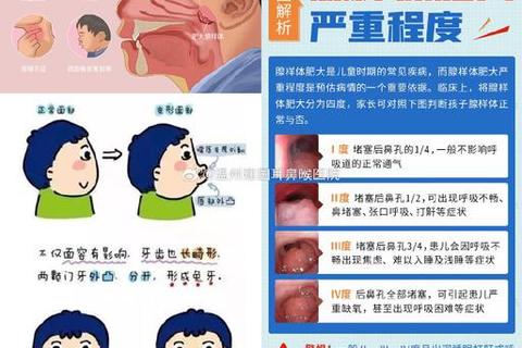 儿童腺样体肥大治疗策略解析：手术与保守疗法对比指南