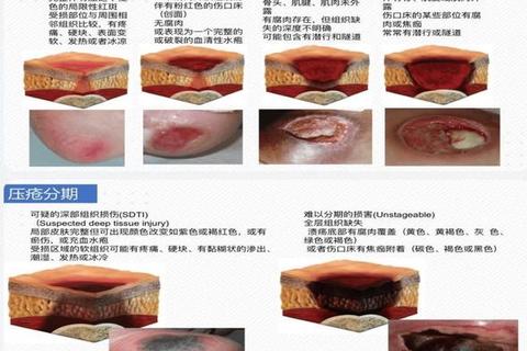 褥疮药物治疗方案-科学用药与护理要点全解析