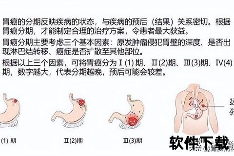 胃癌晚期生存期解析-关键影响因素与预后展望