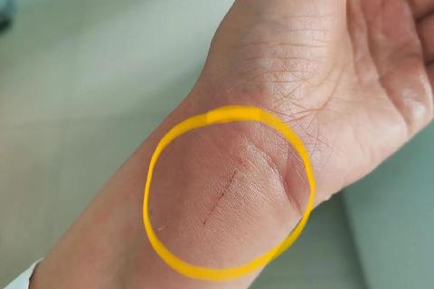 小孩被猫抓伤轻微破皮-打针必要性与处理建议