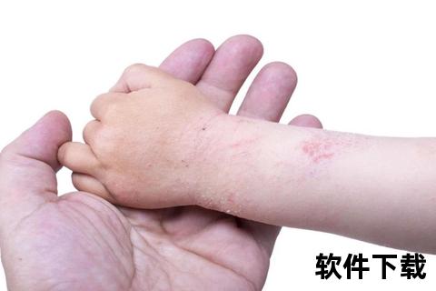 幼童手部湿疹实拍：红肿_瘙痒症状与家庭护理要点解析