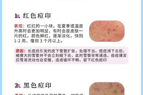 月经不调会导致长痘吗_解析激素失衡与皮肤问题的内在关联