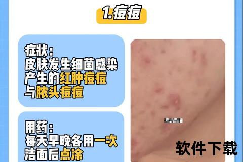 毛囊炎外用药膏选择指南-正确使用步骤与皮肤护理建议 毛囊炎外用药膏选择指南-正确使用步骤与皮肤护理建议