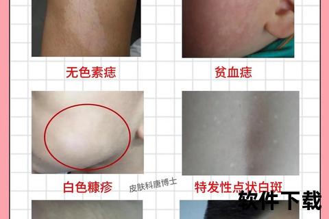 儿童脸上白斑原因解析：白色糠疹与白癜风等5种皮肤病
