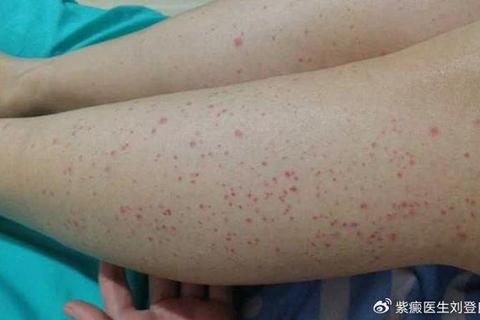 复方芦丁片治疗紫癜效果解析_作用机制与临床应用探讨