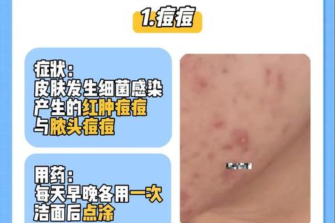 毛囊炎药物治疗指南-正确用药方法与护理建议解析