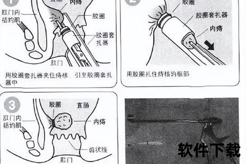 女性结扎手术步骤详解：方法与注意事项解析