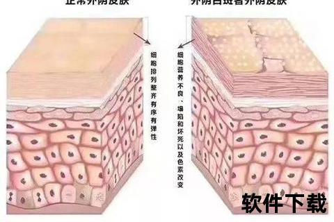 外阴白斑解析:症状表现_发病原因及治疗方法详解 外阴白斑解析:症状表现_发病原因及治疗方法详解