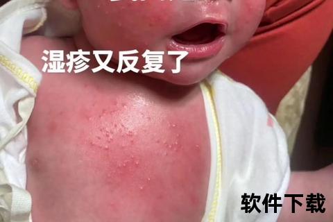 湿疹与维生素D3关联解析:缺乏症及营养干预策略 湿疹与维生素D3关联解析:缺乏症及营养干预策略