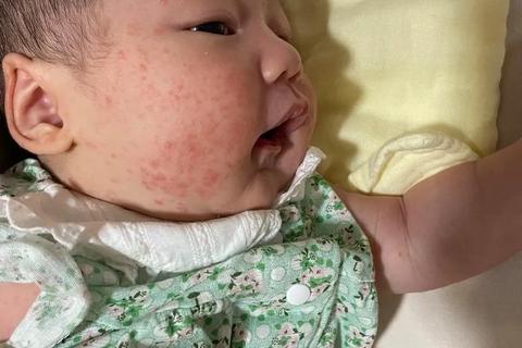 新生儿脸上小红疙瘩解析-痤疮_热疹等8大诱因与处理建议