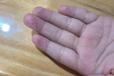 小孩手指脱皮原因解析及科学护理方法