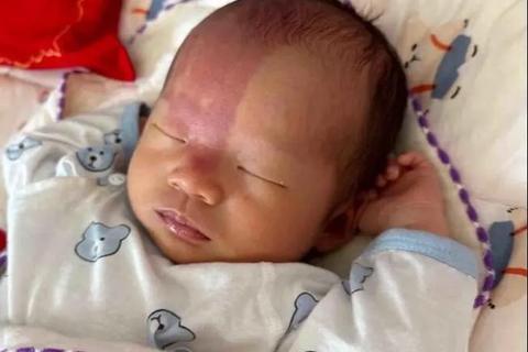 新生儿胎记成因揭秘：遗传与环境如何塑造独特印记