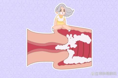 碳酸氢钠治疗妇科病_霉菌感染辅助疗法与使用解析