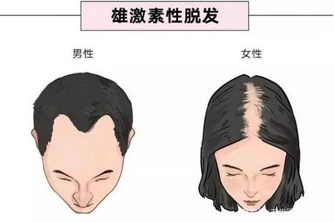 月经不调会导致脱发吗_解析荷尔蒙失衡与头发健康关联