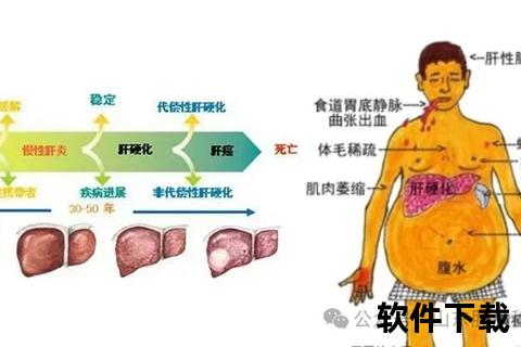 肝硬化腹水患者生存期解析-影响因素与预后展望 肝硬化腹水患者生存期解析-影响因素与预后展望