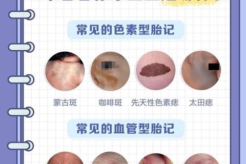 新生儿红斑与胎记区别解析：特征识别及常见误区说明