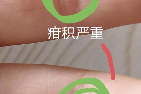 小儿疳积手指症状解析：黄水溢出与四缝穴诊断