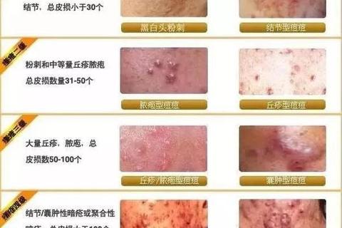 丘疹安全用药指南：科学选药与正确使用技巧