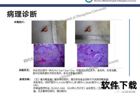 畸胎瘤确诊方法解析：影像学检查与病理诊断流程