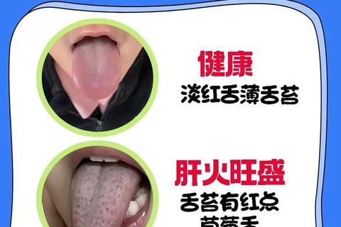 小儿舌苔厚白原因解析-家长必知的健康信号与应对方法