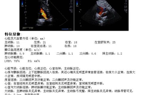动脉导管未闭新生儿发病率_临床特征及治疗策略分析