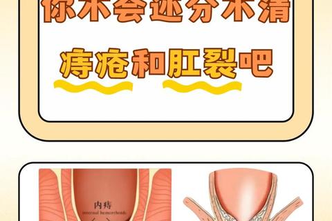 复方硫酸氢黄连素软膏_外痔肛裂抗菌止痛外用指南