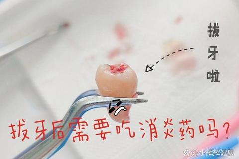 拔牙后必须吃消炎药吗_关键因素与科学用药建议