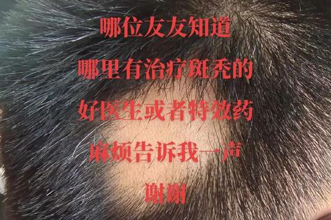 斑秃外用药临床疗效解析-作用机制与治疗优化策略探讨 斑秃外用药临床疗效解析-作用机制与治疗优化策略探讨