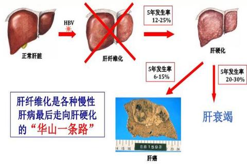 多烯磷脂酰胆碱胶囊：肝细胞膜修复与脂质代谢调节机制探讨