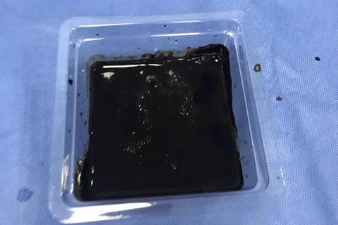 月经有黑色血块_是正常现象还是疾病信号？
