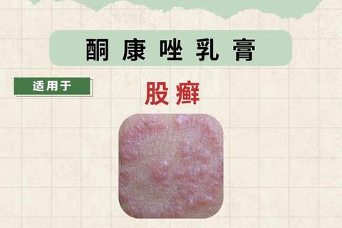 复方酮康挫软膏-顽固性皮肤癣及湿疹感染护理治疗全解析