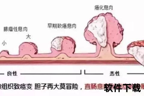 息肉是什么_赘生物本质与癌变风险详解