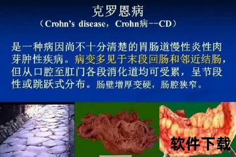 克罗恩病生存期探析_并发症与治疗对寿命的影响