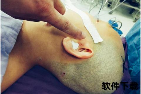 开颅手术后恢复时长解析:重返正常生活的关键阶段