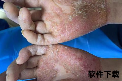 幼童手部湿疹实拍：红肿_瘙痒症状与家庭护理要点解析