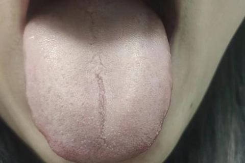 痰湿型月经不调：经色淡黯质地稀薄与舌苔白腻的典型表现