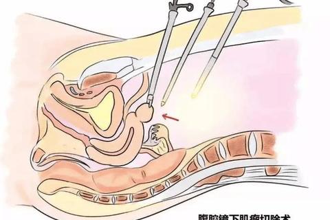 妇科肌瘤诊疗新进展:微创技术应用与术后管理优化 妇科肌瘤诊疗新进展:微创技术应用与术后管理优化