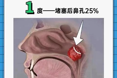 新生儿喘气粗呼哧呼哧_喉软骨发育与鼻腔堵塞解析