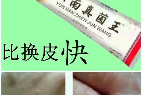 消炎癣湿药膏_草本配方快速止痒祛湿专治湿疹癣症皮肤困扰