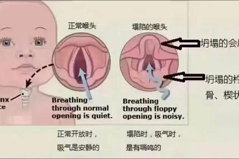 新生儿喘气粗呼哧呼哧_喉软骨发育与鼻腔堵塞解析