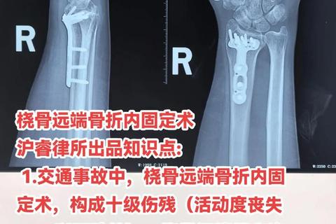手腕骨折手术费用解析：价格范围及影响因素说明
