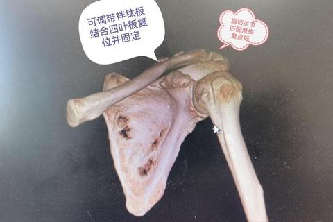 肩膀脱臼手术费用解析-价格范围及影响因素全指南